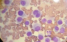 220px-canine_histiocytoma_cytology-7871499